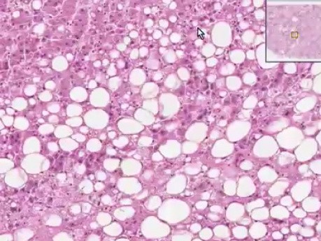 Esteatosis 2 - histopatología - hígado