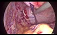 Miomectomía múltiple laparoscópica