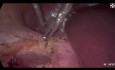 Adrenalectomía transperitoneal derecha laparoscópica