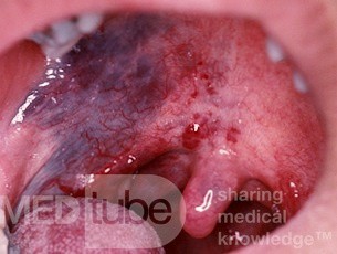 Malformación vascular del paladar