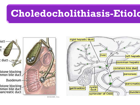 Ictericia obstructiva