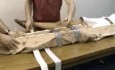 Fractura de fémur con férula de emergencia (entablillado)
