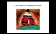 Sexta Rinoplastia de Revisión en deformidad nasal de Binder
