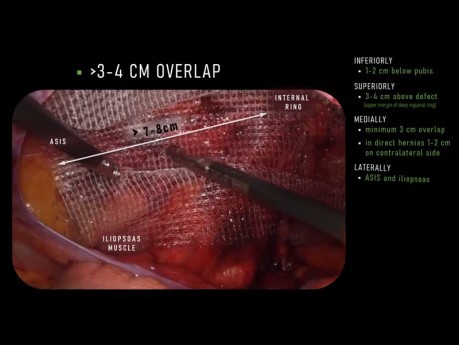 Superposición de malla en TAPP (transabdominal preperitoneal) - consejos para mantener buenos márgenes