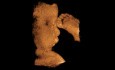 Labio leporino - imagen de ultrasonido 3D