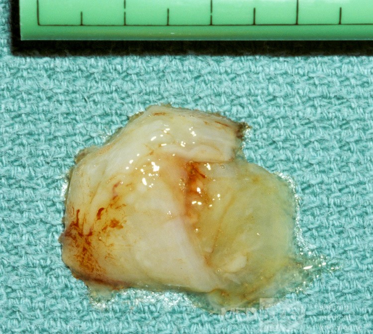 Hipoplasia del seno maxilar tipo 2 [contenidos]