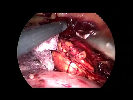 Adrenalectomía laparoscópica retroperitoneal (feocromocitoma)