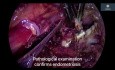 Endometriosis profunda del parametrio y enfermedad peritoneal difusa - Peritonectomía del compartimiento posterior 