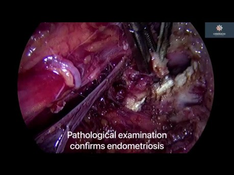 Endometriosis profunda del parametrio y enfermedad peritoneal difusa - Peritonectomía del compartimiento posterior 