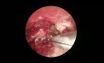 Cirugía del colesteatoma, abordaje endoscópico y microscópico