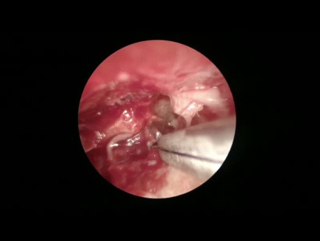 Cirugía del colesteatoma, abordaje endoscópico y microscópico