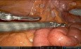 Colectomía izquierda robótica para la enfermedad diverticular