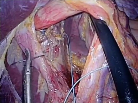 Reducción de hernia de hiato laparoendoscópica de sitio único (LESS) y fundoplicatura de Nissen