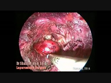 Tiroidectomía transaxial endoscópica