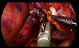 Abordaje caudal de hemihepatectomía derecha laparoscópica sin maniobra de Pringle