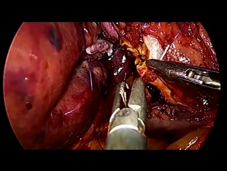 Abordaje caudal de hemihepatectomía derecha laparoscópica sin maniobra de Pringle