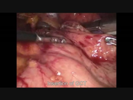 Gastrectomía en manga laparoscópica debido a un GIST gástrico
