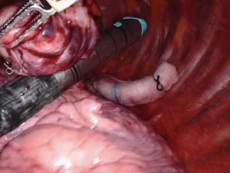 Resección de masa pulmonar en cuña asistida por robot