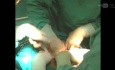 Mioma intraligamentario con / sin gestación. Miomectomía.