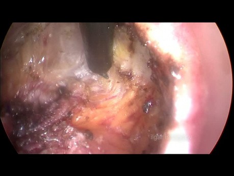 Escisión mesorrectal total transanal para el cáncer de recto distal