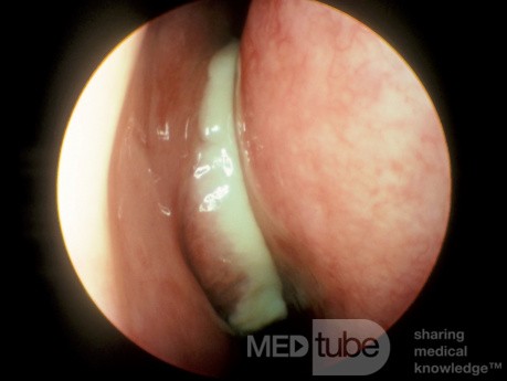 Sinusitis maxilar aguda [antes del tratamiento]