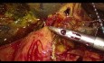Bypass doble laparoscópico en el cáncer de páncreas irresecable