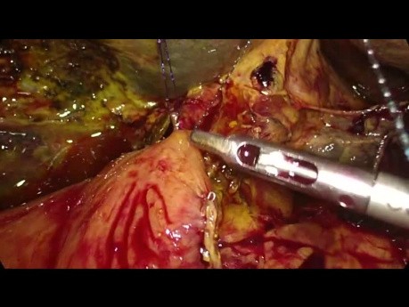 Bypass doble laparoscópico en el cáncer de páncreas irresecable