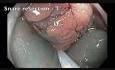 Perforación del colon tras RME - D
