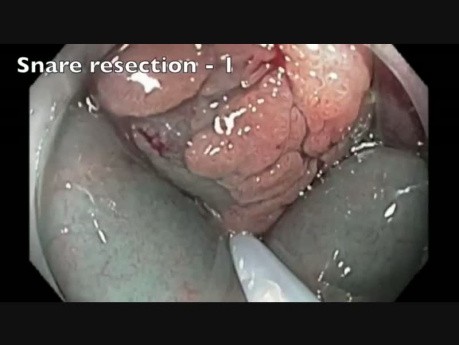 Perforación del colon tras RME - D