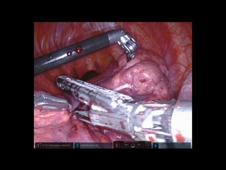 Segmentectomía posterior robótica del lóbulo superior derecho del pulmón