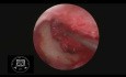 Miringoplastia endoscópica HD
