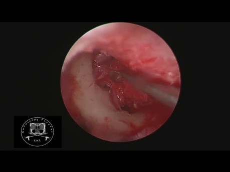 Miringoplastia endoscópica HD