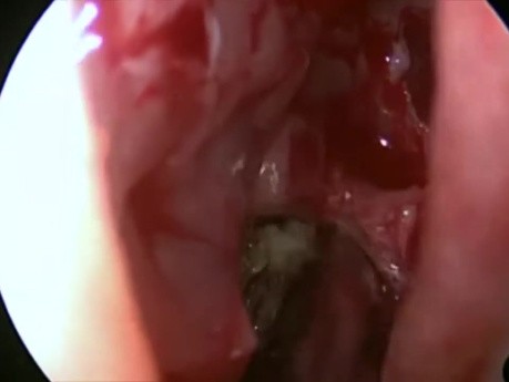 Cirugía de los senos paranasales - Sinusitis fúngica