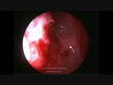 Reparación endoscópica de otorrea por líquido cefalorraquídeo
