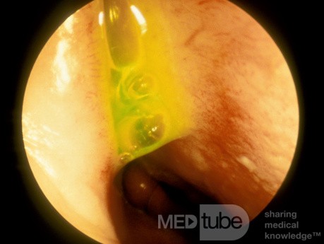 La prueba de fluoresceína para la rinorrea del LCR