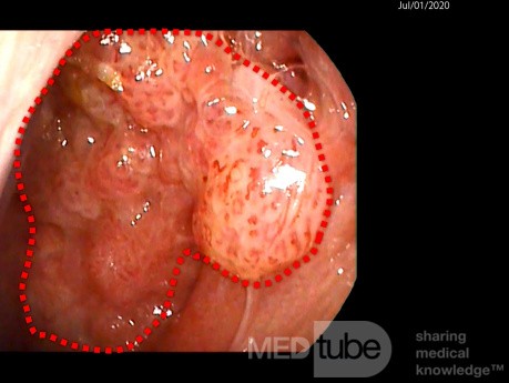 Papilomatosis Nasofaríngea