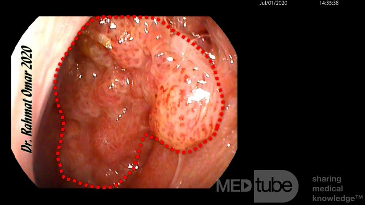 Papilomatosis Nasofaríngea