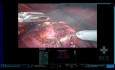 Consejos y trucos: nefrectomía parcial robótica de un tumor 100 % endofítico