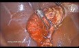 Colecistectomía laparoscópica en la colecistitis fibrótica crónica