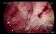 Extirpación por enterólisis laparoscópica del hidrosalpinx izquierdo (Parte 2)