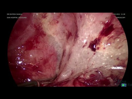 Extirpación por enterólisis laparoscópica del hidrosalpinx izquierdo (Parte 2)