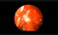 Neuropatía óptica traumática - Descompresión endoscópica