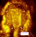 Cavidad uterina normal en imagen 3D