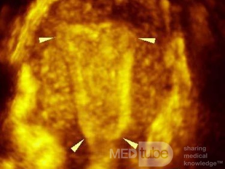Cavidad uterina normal en imagen 3D