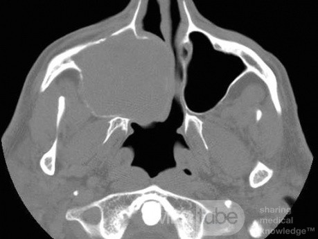Mucocele gigante del seno maxilar [tomografía computarizada - vista axial]