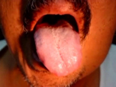 Fasciculaciones de una lengua
