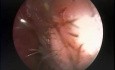 Mucocele del seno frontal - tratamiento endoscópico