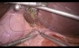 Sutura laparoscópica de úlcera duodenal con parche de Graham