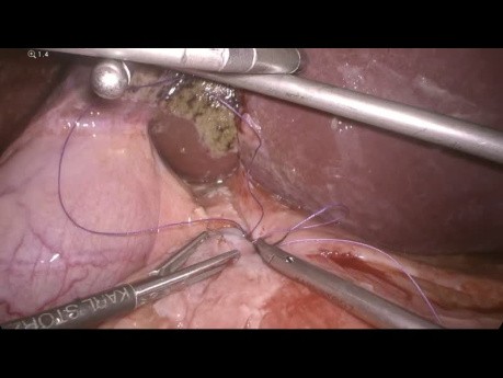 Sutura laparoscópica de úlcera duodenal con parche de Graham