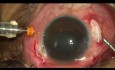 Recuperación de endoftalmitis postraumática de sin percepción de luz (no PL)